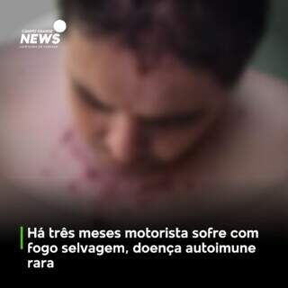 Veja mais em https://www.campograndenews.com.br/cidades/capital/ha-tres-meses-motorista-sofre-com-fogo-selvagem-doenca-autoimune-rara