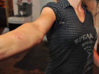 Sara mostra marca no braço da luta com os bandidos. (Foto: João Garrigó)