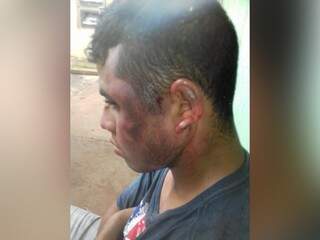 Rosto de Douglas Carneiro Cardoso após as agressões (Foto: Bruna Pasche)