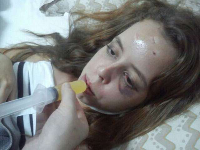 Jovem com suspeita de agress&atilde;o do namorado n&atilde;o ter&aacute; sequelas no rosto 