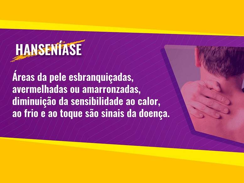 Tratamento correto impede sequelas em pacientes diagnosticados com  hanseníase - Cidades - Campo Grande News