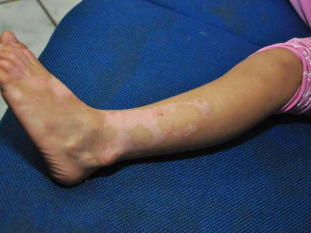  Menino salva irm&atilde;, mas tem 60% do corpo queimado ao brincar com &aacute;lcool