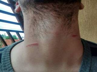 Edgard postou no Facebook fotos dos ferimentos que teve no pescoço. (Foto: Facebook)