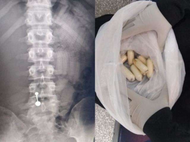 Raio-x revela 50 c&aacute;psulas de coca&iacute;na no est&ocirc;mago de mulher rumo &agrave; It&aacute;lia