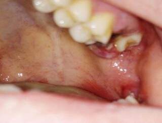 Leitora mostra o dente que foi extraído errado pelo acadêmicos da faculdade de odontologia, o correto seria extrair o siso (Foto Arquivo Pessoal)