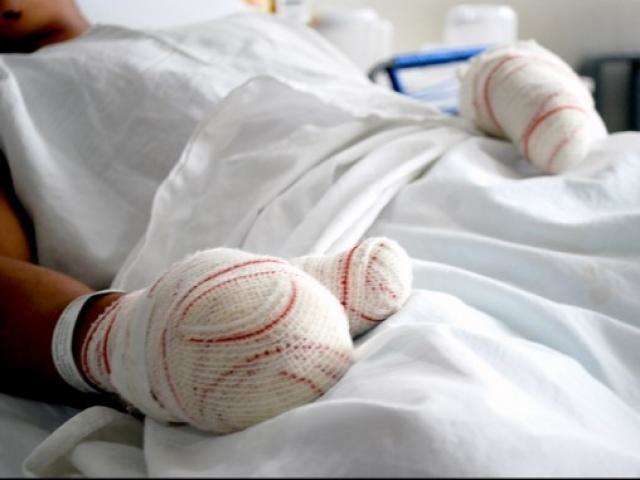 Durante fim de ano, Santa Casa recebe oito pacientes com queimaduras 