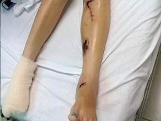 Vítima teve 4 dedos dos pés mutilados no acidente. (Foto: JP News) 