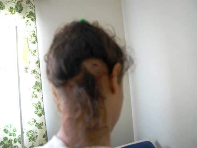  Adolescente &eacute; atacada por c&atilde;es e tem parte do couro cabeludo arrancado 