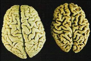 O Alzheimer é uma doença neurodegenerativa que se manisfesta por uma perda acentuada e progressiva da memória. (Foto: ilustração) 