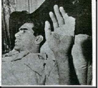Castilho ainda com o curativo no dedo logo depois da cirurgia em 1957 (Foto: Google)