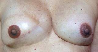 Na foto, auréola foi micropigmentada na mama esquerda. (Foto: Arquivo Pessoal)