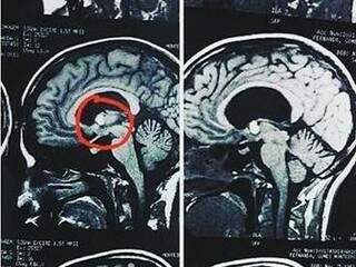 O cisto do tipo colóide se formou no meio do cérebro se se agravou para um quadro de hidrocefalia. (Foto: Arquivo Pessoal) 