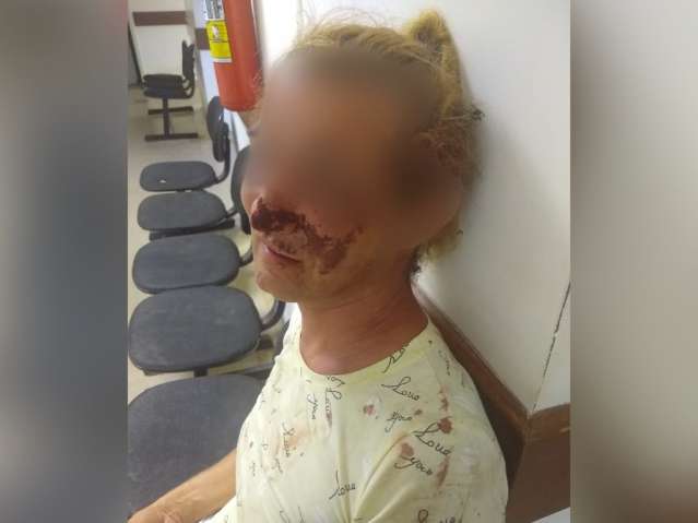 Agredida no ch&atilde;o, mulher tem nariz arrancado com mordida