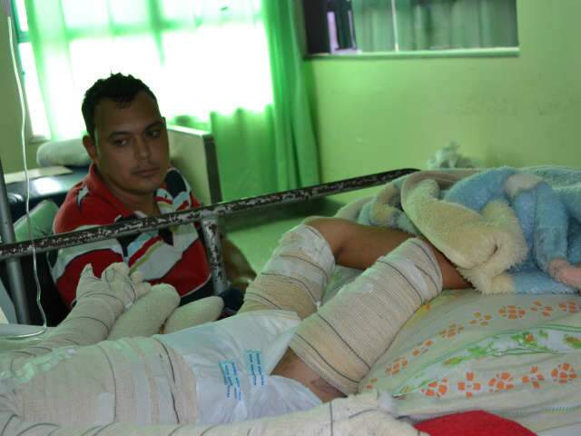  Com recupera&ccedil;&atilde;o lenta, queimaduras deixam marca no corpo e na vida