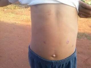 Além de ser abusado, menino era queimado na barriga com pontas de cigarro. (Foto: Rádio Caçula)