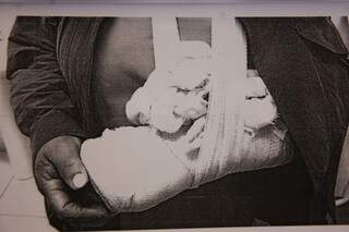 Mulher de 57 anos tem o braço quebrado pelo genro (Foto: reprodução)