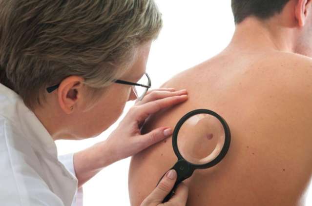 Dermatologistas v&atilde;o atender popula&ccedil;&atilde;o no HU para prevenir c&acirc;ncer de pele
