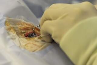 Captação de córnea é procedimento simples e dura 40 minutos (Foto: Divulgação)