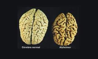 Pfizer ocultou remédio que poderia prevenir o Alzheimer