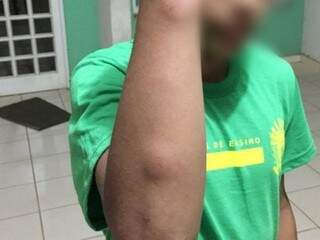 Garoto teve vários hematomas ao ser agredido com cabo de vassoura (Foto: Ângela Bezerra / Edição de Notícias)