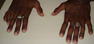 Ricardo da Silva tem 12 dedos nas mãos. (Foto: Divulgação)