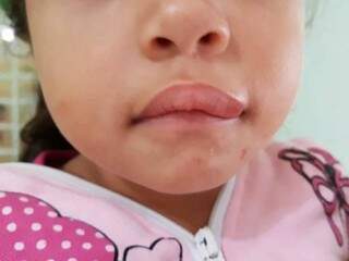 Boca da criança inchada após ser agredida pelo padrasto (Foto: PC de Souza/ Edição MS)