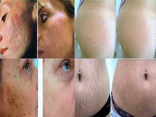 Antes e depois da micropuntura, um tratamento facial contra marcas, e tratamento para camuflar as estrias.