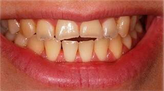 Dentes de paciente antes da técnica: eram de tamanho, formato e cor assim. 