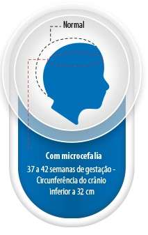 Minist&eacute;rio da Sa&uacute;de contabiliza nove casos de microcefalia em MS