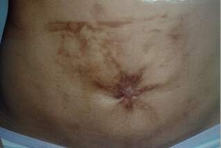 Depois de duas plásticas, paciente perdeu o umbigo e ficou com a barriga tomada por manchas (Foto: Reprodução)