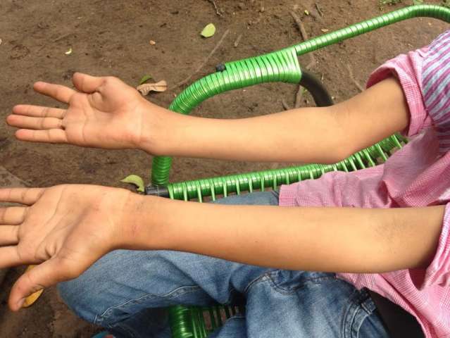 Ap&oacute;s 4 meses com bra&ccedil;o quebrado, garoto consegue encaixe em consulta