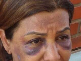 Vítima de assalto mostra hematomas no rosto provocados por socos de assaltante (Foto: Adilson Domingos)