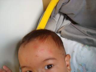 Anderson tem um filho de seis meses, e mostra a testa da criança cheia de marcas de picadas de mosquito.