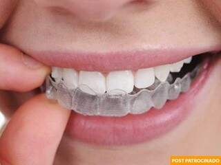 Alinhadores dentários são revolução no tratamento ortodôntico. (Foto: Divulgação)