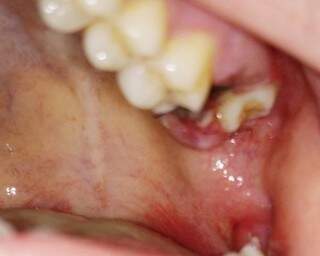 Jovem alega que teve dente extraído errado durante atendimento na faculdade de odontologia da UFMS, semana passada (Foto Arquivo Pessoal)