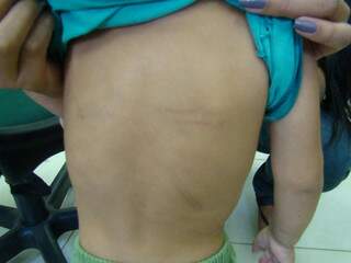 Criança tinha marcas de agressão nas costas. (Foto: Divulgação Polícia Civil)