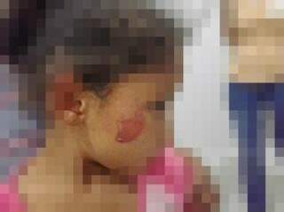 Criança ficou com lesão na face (foto: Alcinopolis.com)