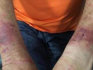 Vítima ficou com os braços machucados que foram amarrados pelos bandidos (Foto: Sigo News) 