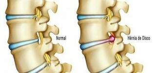 Discos da coluna são comprimidos e núcleo acaba pressionando as raízes nervosas da coluna vertebral.