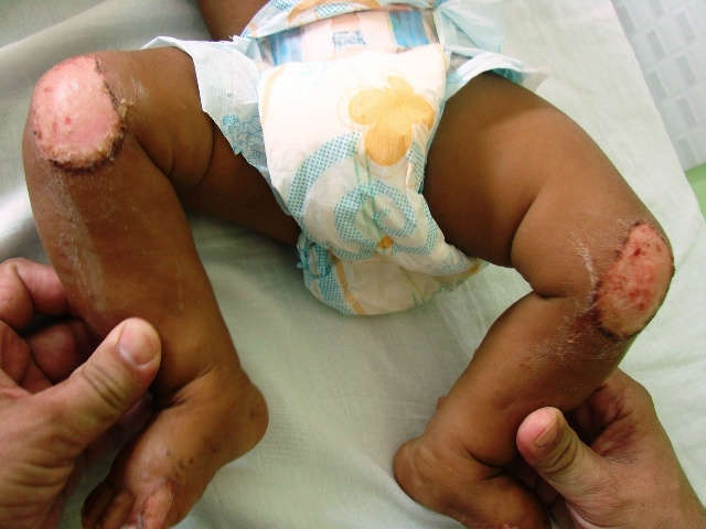  Mulher &eacute; suspeita de queimar filho de seis meses em Lad&aacute;rio