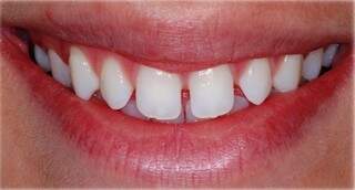 As lâminas de porcelana permitem também correção de espaço entre os dentes.