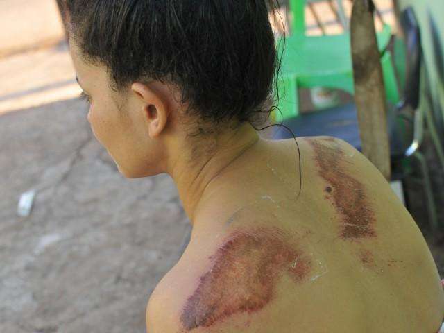 Atropelada pelo ex retirou pedido de prote&ccedil;&atilde;o 19 dias depois de ser espancada