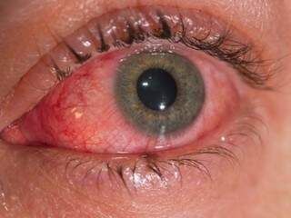 Vermelhidão nos olhos sem secreção é um dos sintomas. (Foto: Reprodução/Internet)