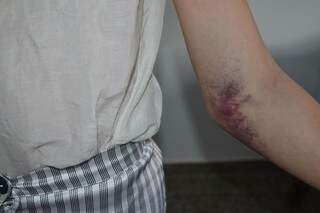 Jovem está com ferimentos em várias partes do corpo, como o braço. (Foto: Edição MS)