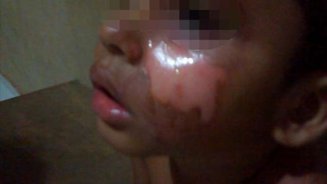 Menino ferido com feij&atilde;o quente jogado pela m&atilde;e sofreu queimaduras de 3&deg; grau