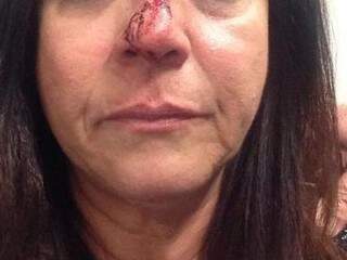 Professora ficou com rosto ferido depois que condutor arremessou lata de cerveja em seu rosto (Foto: Divulgação/Facebook)