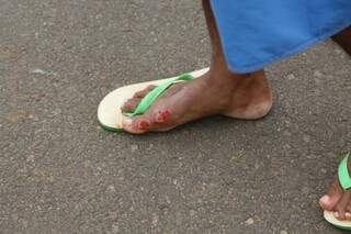 Detalhes do pé do pai, atingido por motociclista irresponsável no Tarsila do Amaral (Foto: Cleber Gellio)