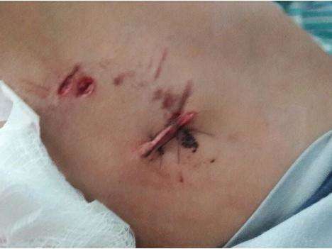 Menino vai buscar bola na casa no vizinho e &eacute; atacado por pitbull