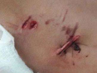 Pipa nunca mais, diz menino que teve panturrilha dilacerada por  pit bull 