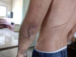 Elso mostra pontos no braço e marca das agressões nas costas. (Foto: Arquivo Pessoal)